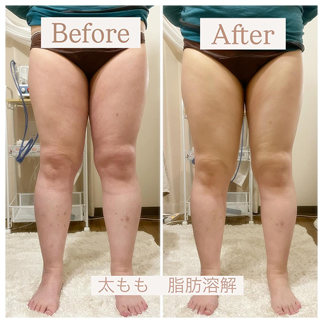 脚ビフォーアフター