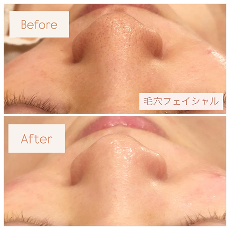 フェイシャルビフォーアフター